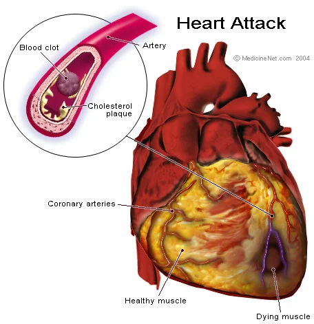 Heart Attacks