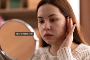 Pigmentation causes