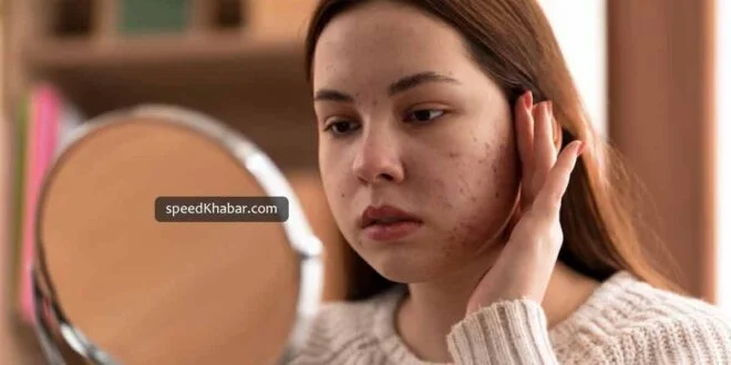 Pigmentation causes