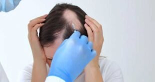 alopecia